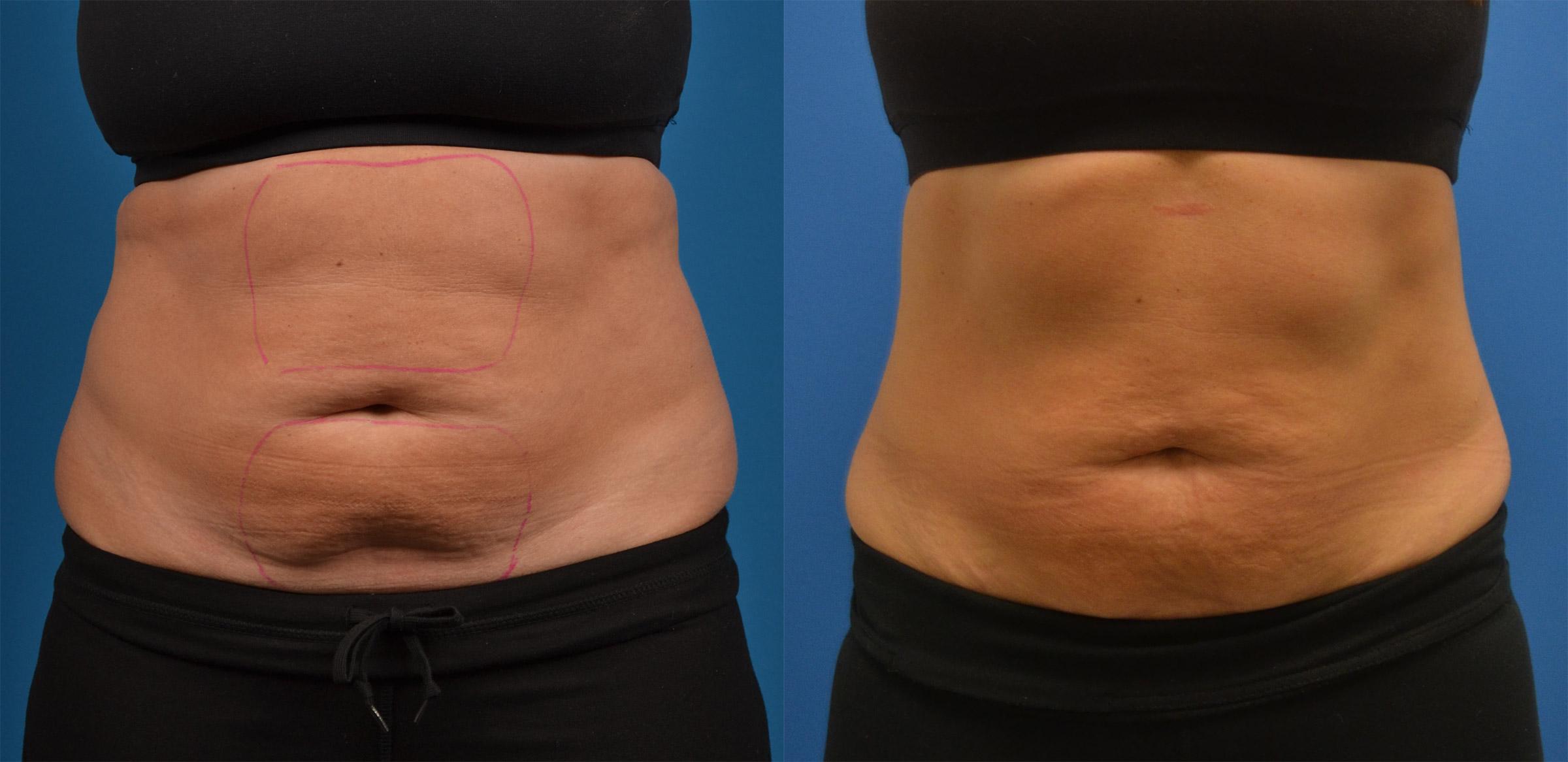 Sculpsure Melbourne | Non-Surgical Fat Reduction Orlando, FL